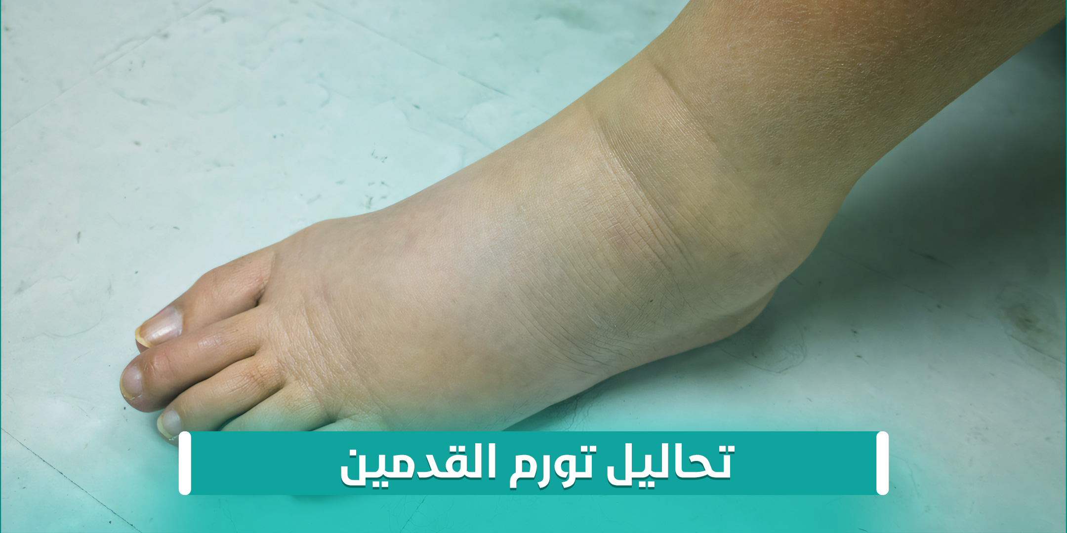 تحاليل تورم القدمين